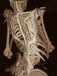 In this handout photo provided by the University of Pennsylvania, a CAT scan showing the back of an unnamed 12-year-old patient of Dr. Frederick Kaplan, showing bone formation typical of FOP, is shown. Scientists have discovered a mutant gene that triggers the body to form a second, renegade skeleton, solving the mystery of a rare disease called FOP that imprisons children in bone for life. The finding, reported Sunday, may one day lead to development of a drug, not only to treat the rare bone disorder, but more common bone buildup related to head and spine trauma, and even sports injuries, the researchers said. (AP Photo/University of Pennsylvania and Nature Genetics)