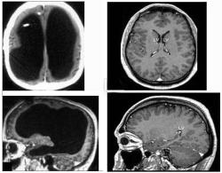The large black space shows the fluid that replaced much of the patients brain (left). For comparison, the images (right) show a typical brain without any abnormalities (Images: Feuillet et al./<I>The Lancet</I>)